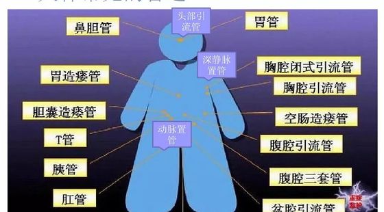 添翼2020-2021&nbsp;ISPN/RN專業(yè)課&nbsp;第20章&nbsp;各種管道護(hù)理